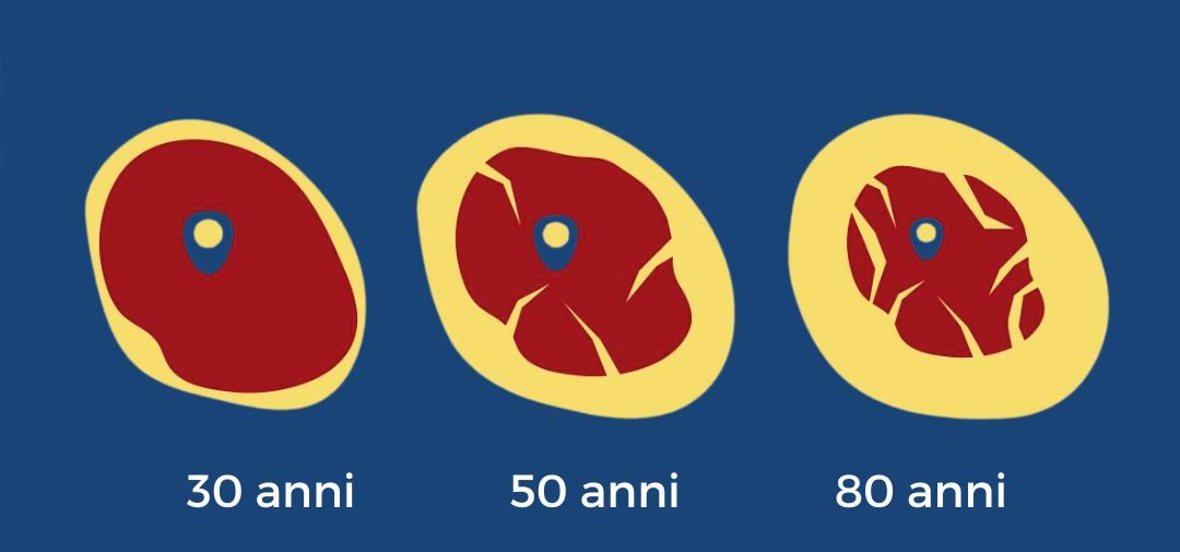 sarcopenia cos è sarcopenia cos è